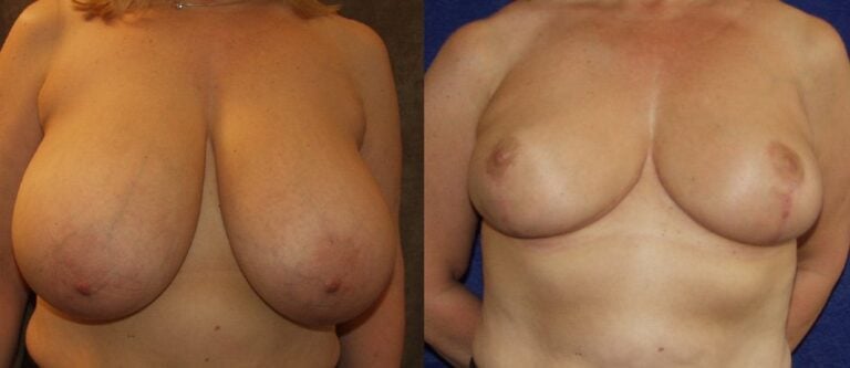 breast-reduction-1000-gm-removal-each-side-4-months-postop