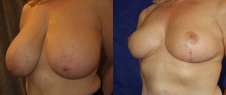 breast-reduction-1000-gm-removal-each-side-4-months-postop-oblique-view