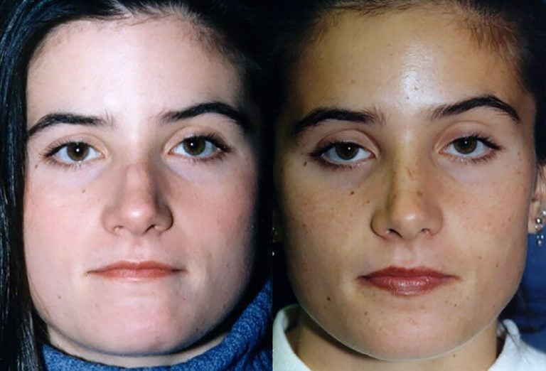 Broad-nose-with-bump-after-bony-fracture-front