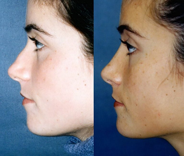 Broad-nose-with-bump-after-bony-fracture-side