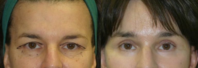 facelift, brow lift, upper & lower eyelids