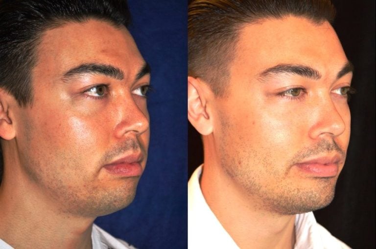 Buccal-fat-excision-and-square-jaw-implant