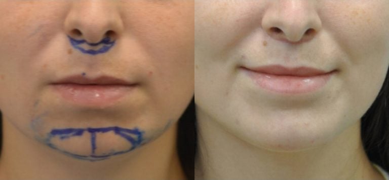 29 year old upper lip shortening with chin implant 3 months after surgery front view