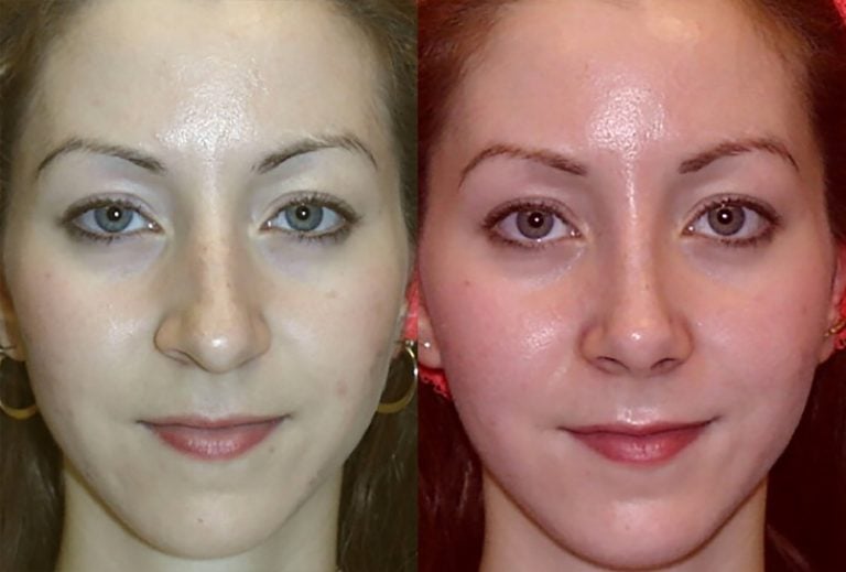 crooked-nose-2-front