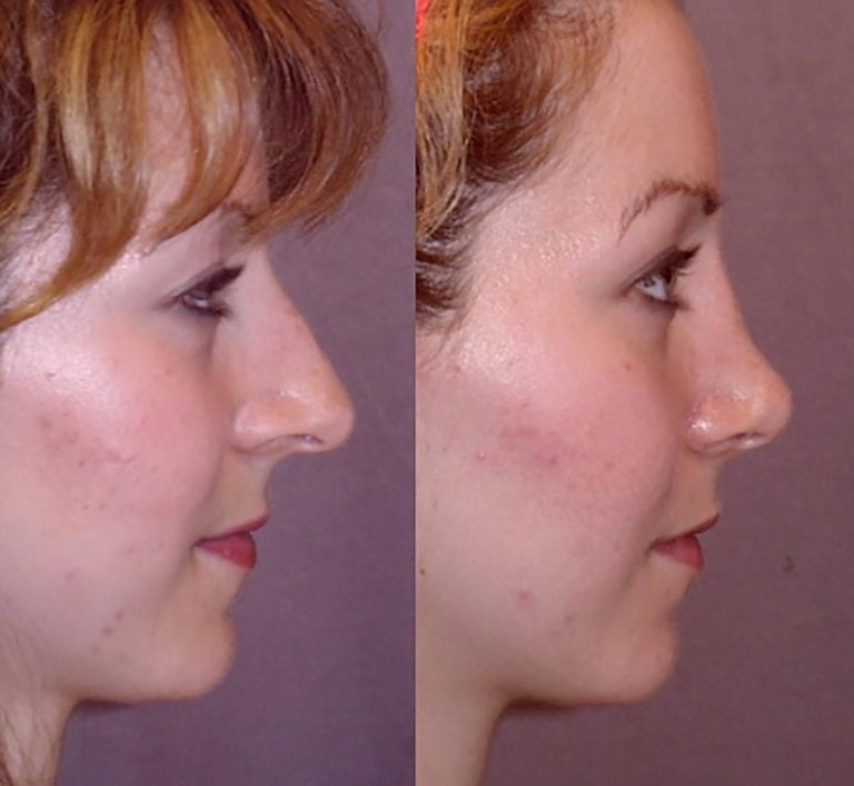 crooked-nose-2-side
