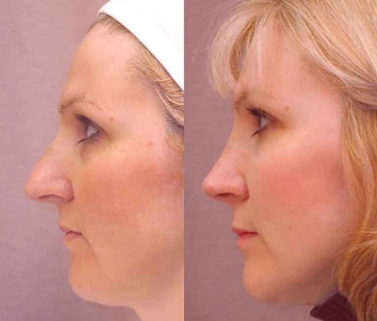 crooked-nose-3-side