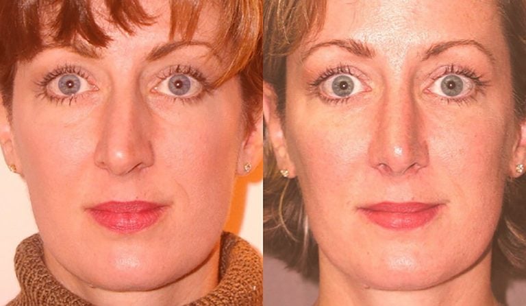 crooked-nose-front