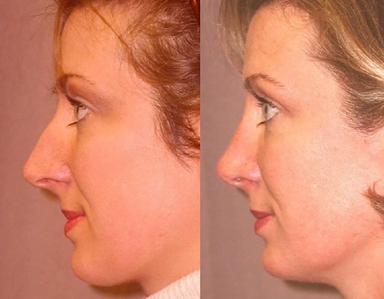 crooked-nose-side