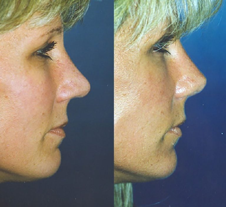 Crooked-nose-with-indented-tip-side