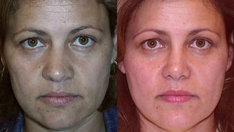 crooked-nose-with-widened-nostrils