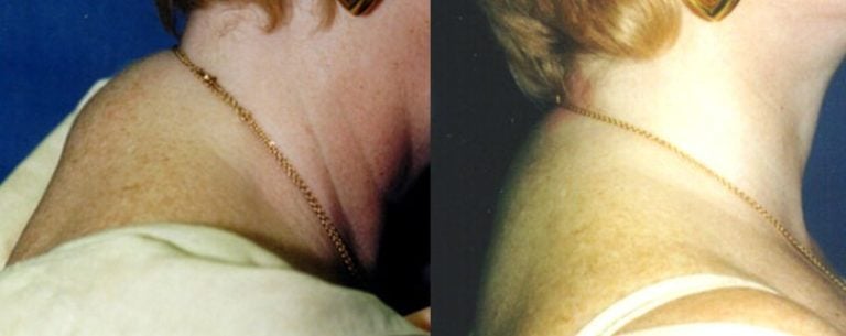 dorsal-hump-liposuction