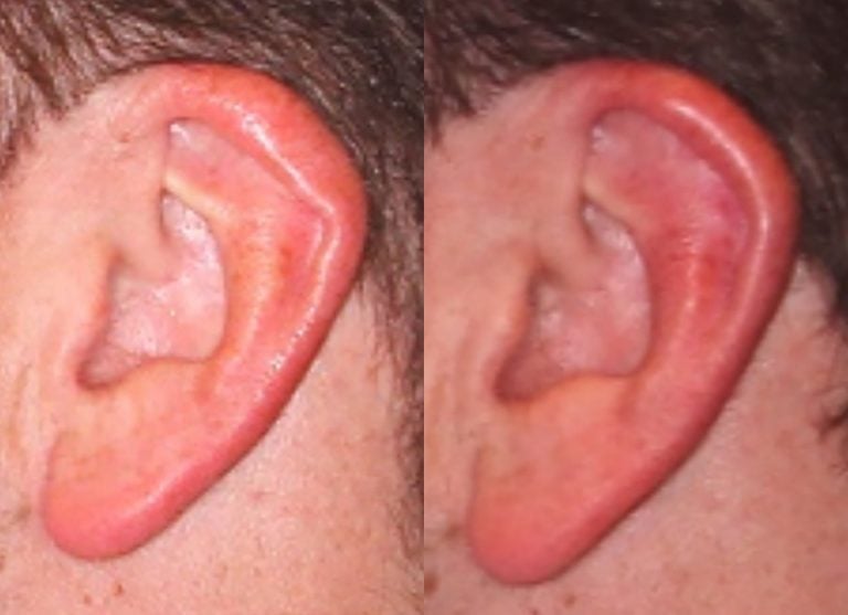 Ear-helical-rim-plasty-before-after