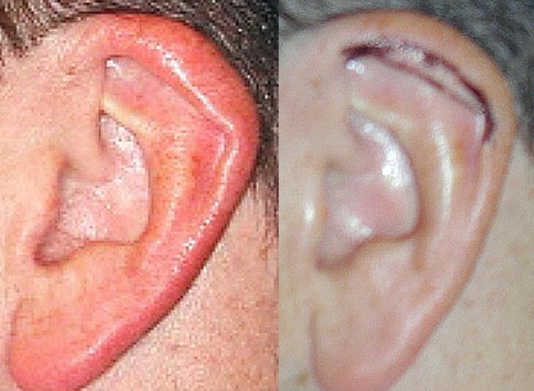 Ear-helical-rim-plasty-planning