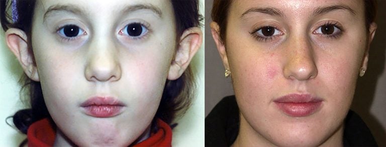 7-year-old female bilateral otoplasty