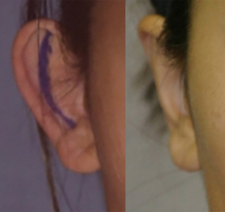 17-year-old female bilateral otoplasty, 2 years, right ear