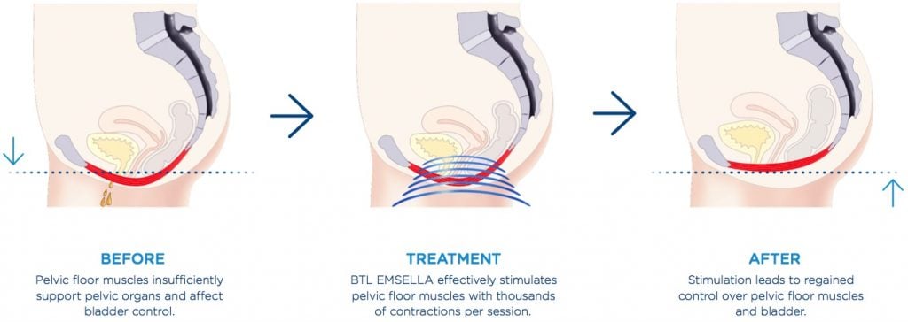 Emsella before treatment after