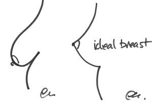 Enlarged ptotic breast left and ideal breast right