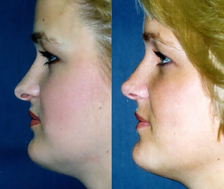 Enlarged tip - side