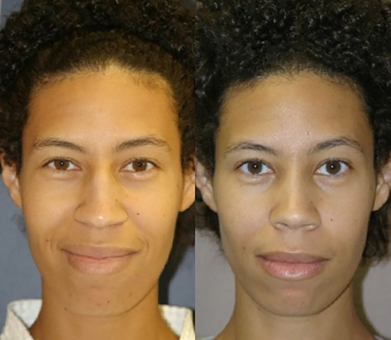 ethnic-rhinoplasty