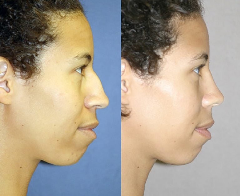 Ethnic Rhinoplasty - side