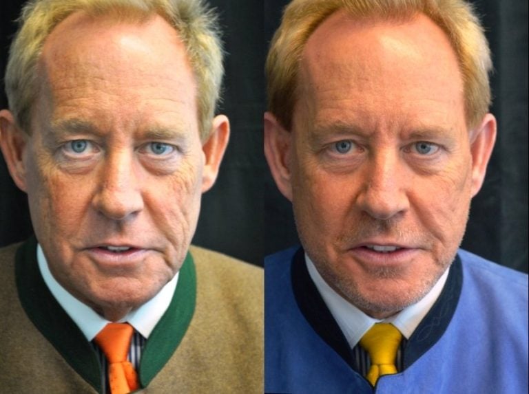 Facelift and submental platysmaplasty front view
