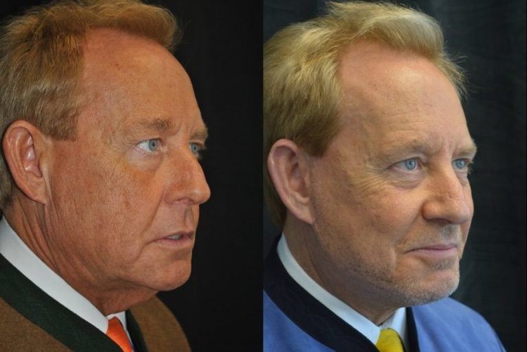 Facelift-and-submental-platysmaplasty-oblique-view