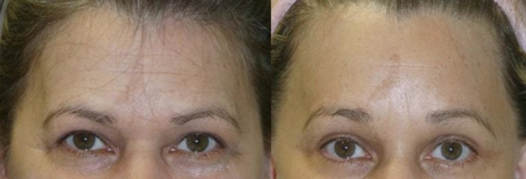 facelift, browlift, upper & lower eyelids