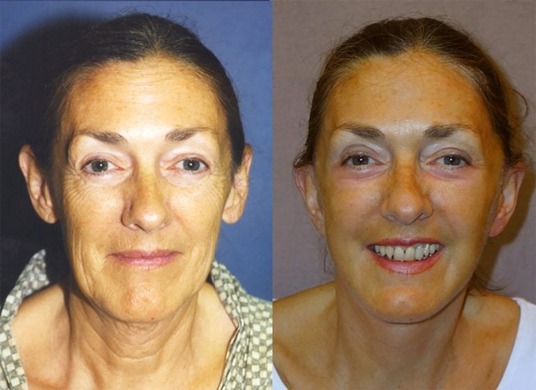 62-year-old facelift, upper and lower eyelids, peel lower eyelids, one year