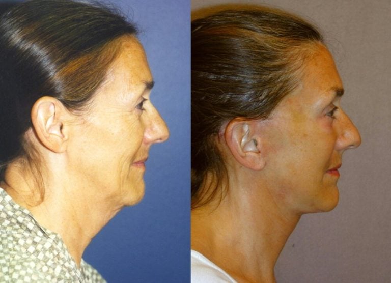 62-year-old facelift, upper and lower eyelids, peel lower eyelids, one year, side