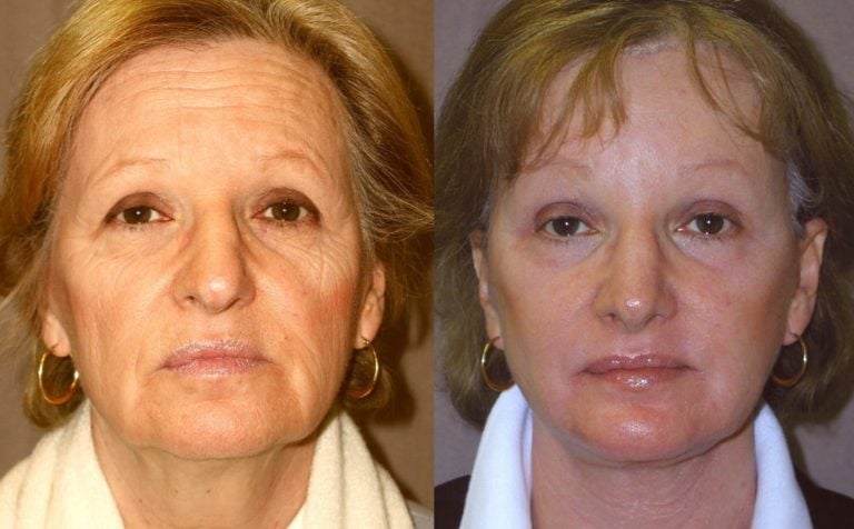 62-year-old facelift, browlift, hairline approach, upper & lower eyelids, chin implant, rhinoplasty subtle without fracture nasal domes, peel lower eyelids & perioral, 4 months