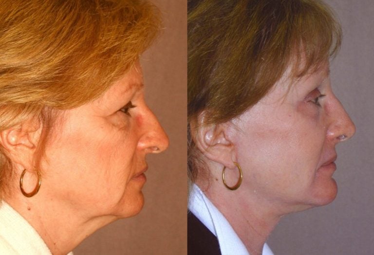 62-year-old facelift, browlift, hairline approach, upper & lower eyelids, chin implant, rhinoplasty subtle without fracture nasal domes, peel lower eyelids & perioral, 4 months, side