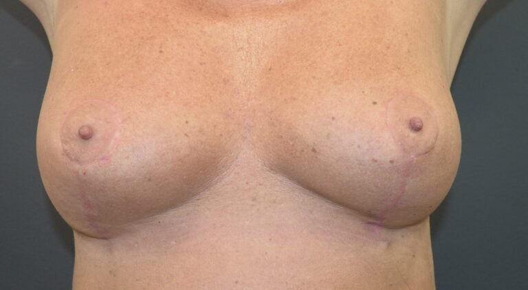 4-months-after-SSAA-arms-up-front-view.
