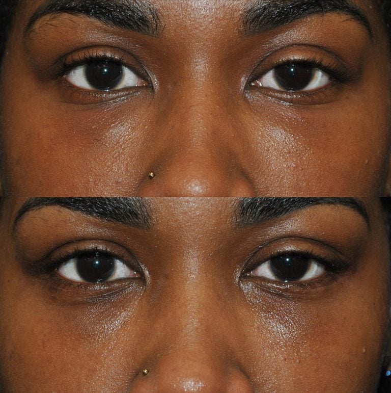 The forward gaze of a blepharoplasty patient three months post-procedure