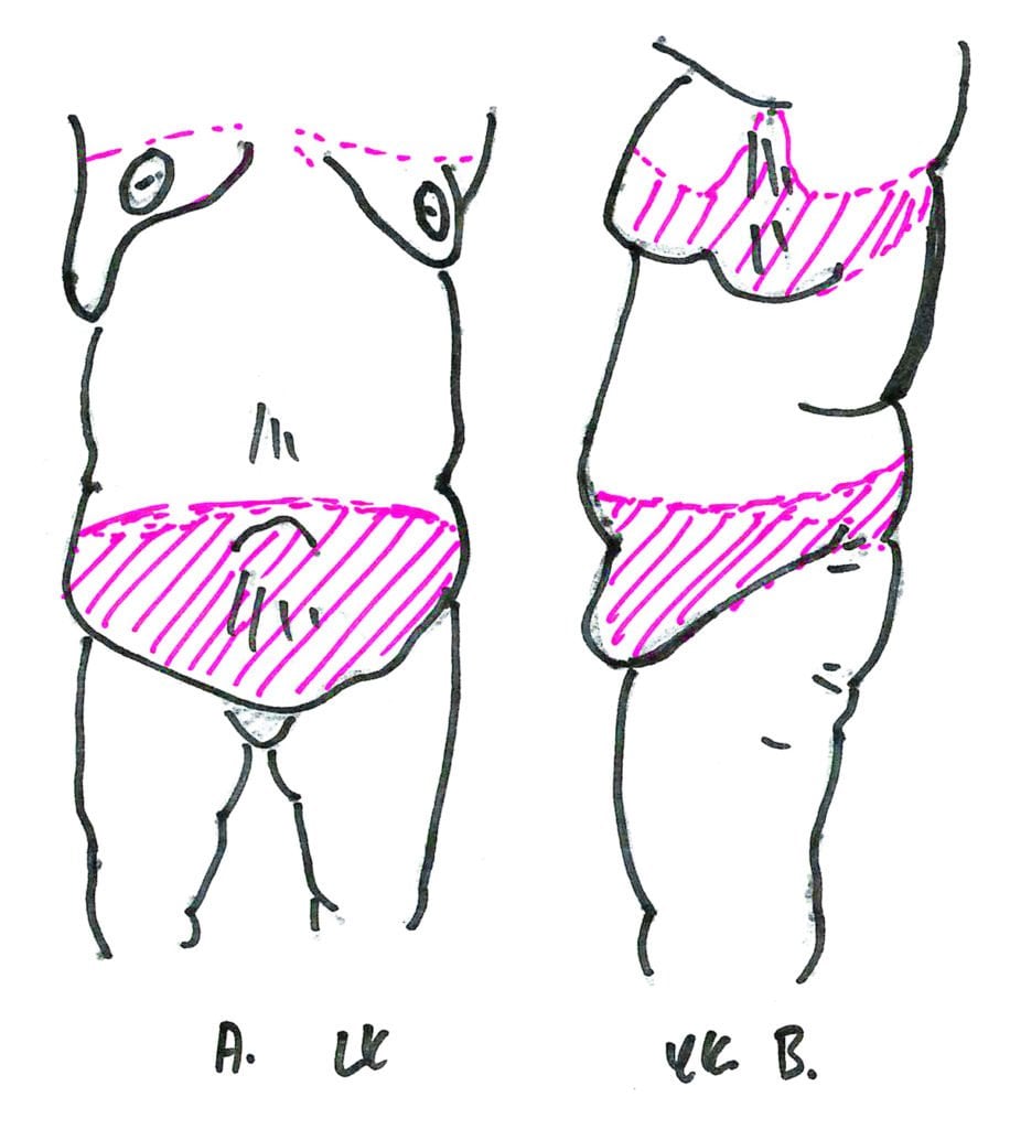 Front and side view panniculectomy and upper body lift with brachioplasty A B