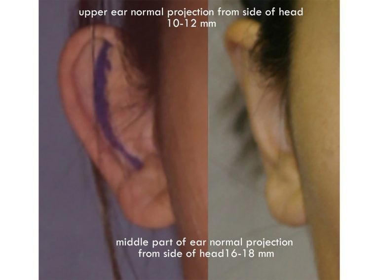 Front of ear, normal projection from side of head