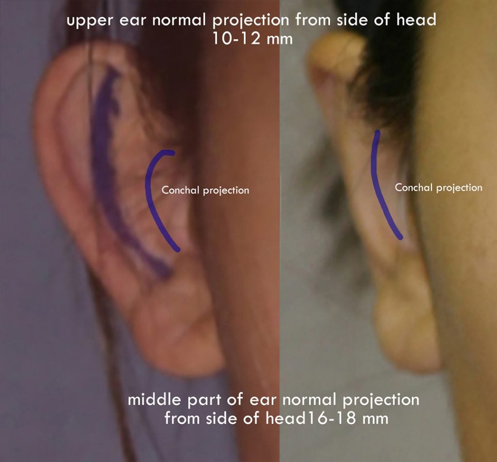 Front of ear normal projection from side of head. conchal projection