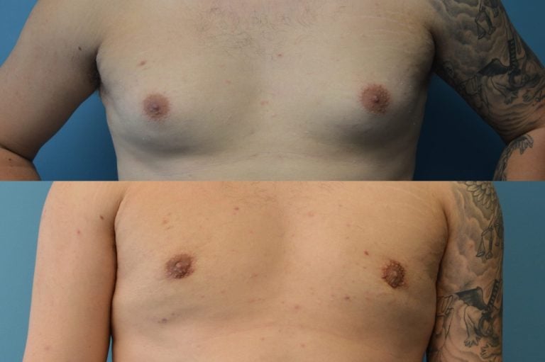 Gynecomastia 2 months after surgery excision liposuction front view