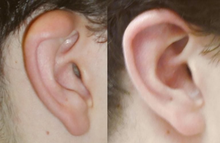 Helical-rim-plasty-side-view