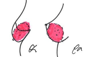 Inferior pedicle side view before and after