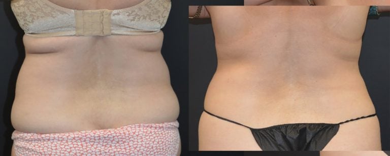 lateral-lipo-flanks-bra-fat-iliac-crest-abdomen-60-year-old-5-month-back-no-markings