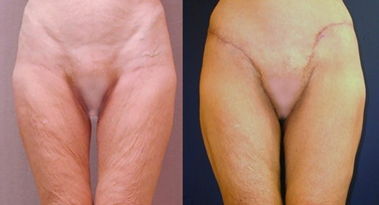 LBL-medial-thigh-lift-front