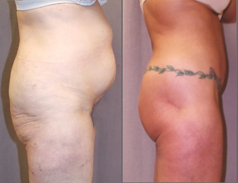 LBL-TATTOO-1500-right-lateral-3.1