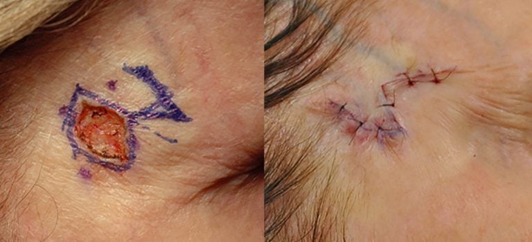 Limberg Flap after Mohs right forehead