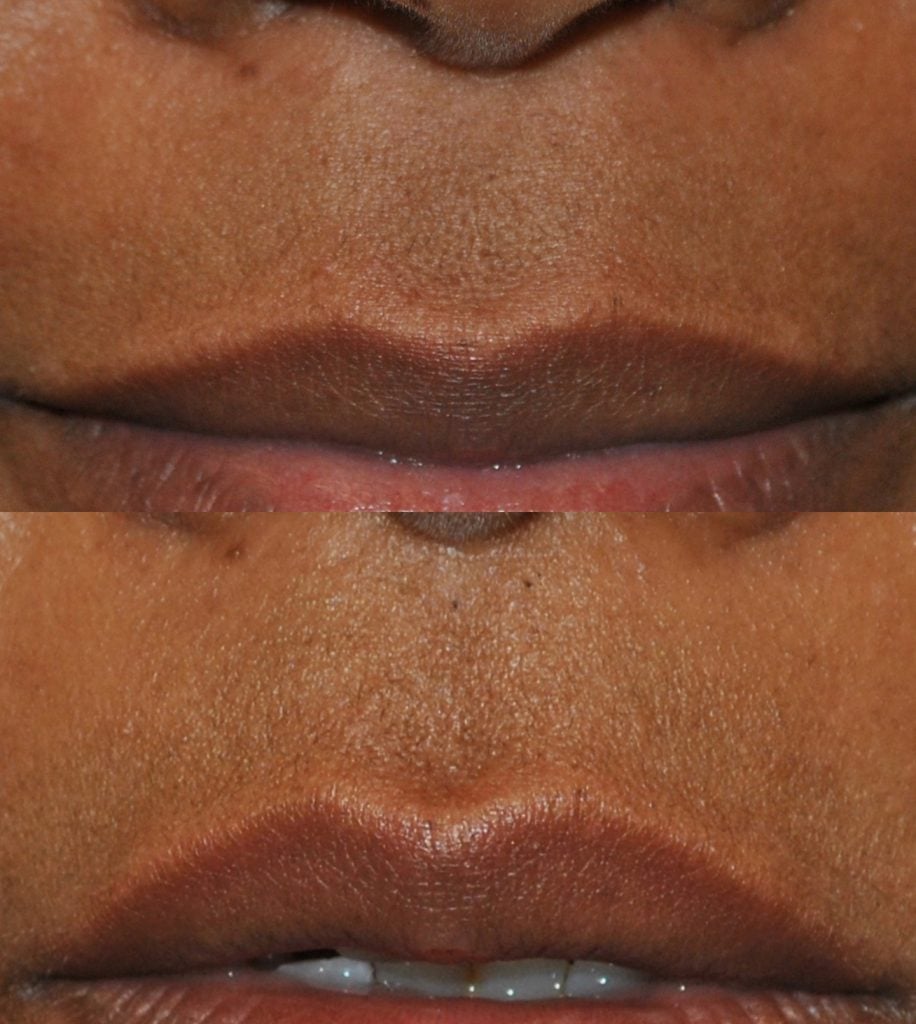 Lip Flip before and after (no filler)