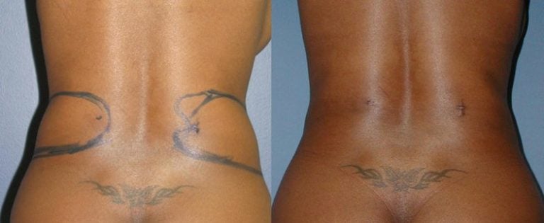 Liposuction tummy and hips