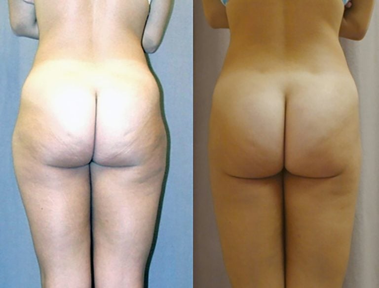 liposuction-hips-and-outer-thighs