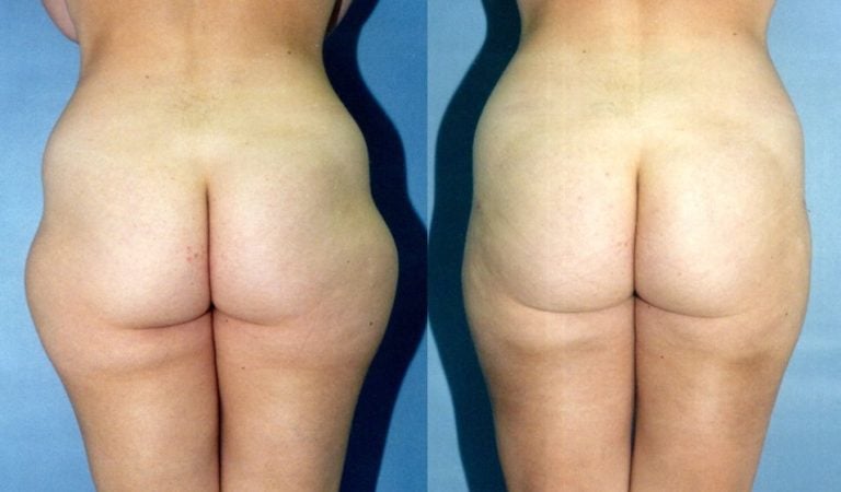 liposuction-hips-and-outer-thighs