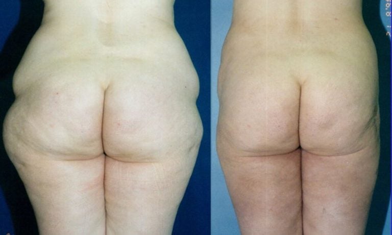 liposuction-hips-and-outer-thighs