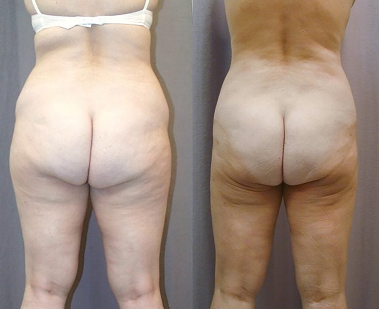 liposuction-hips-bra-fat-outer-and-inner-thighs