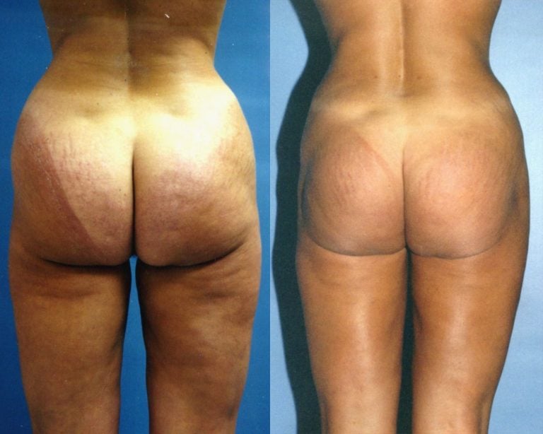 liposuction-hips-inner-thighs-outer-and-back-of-thighs